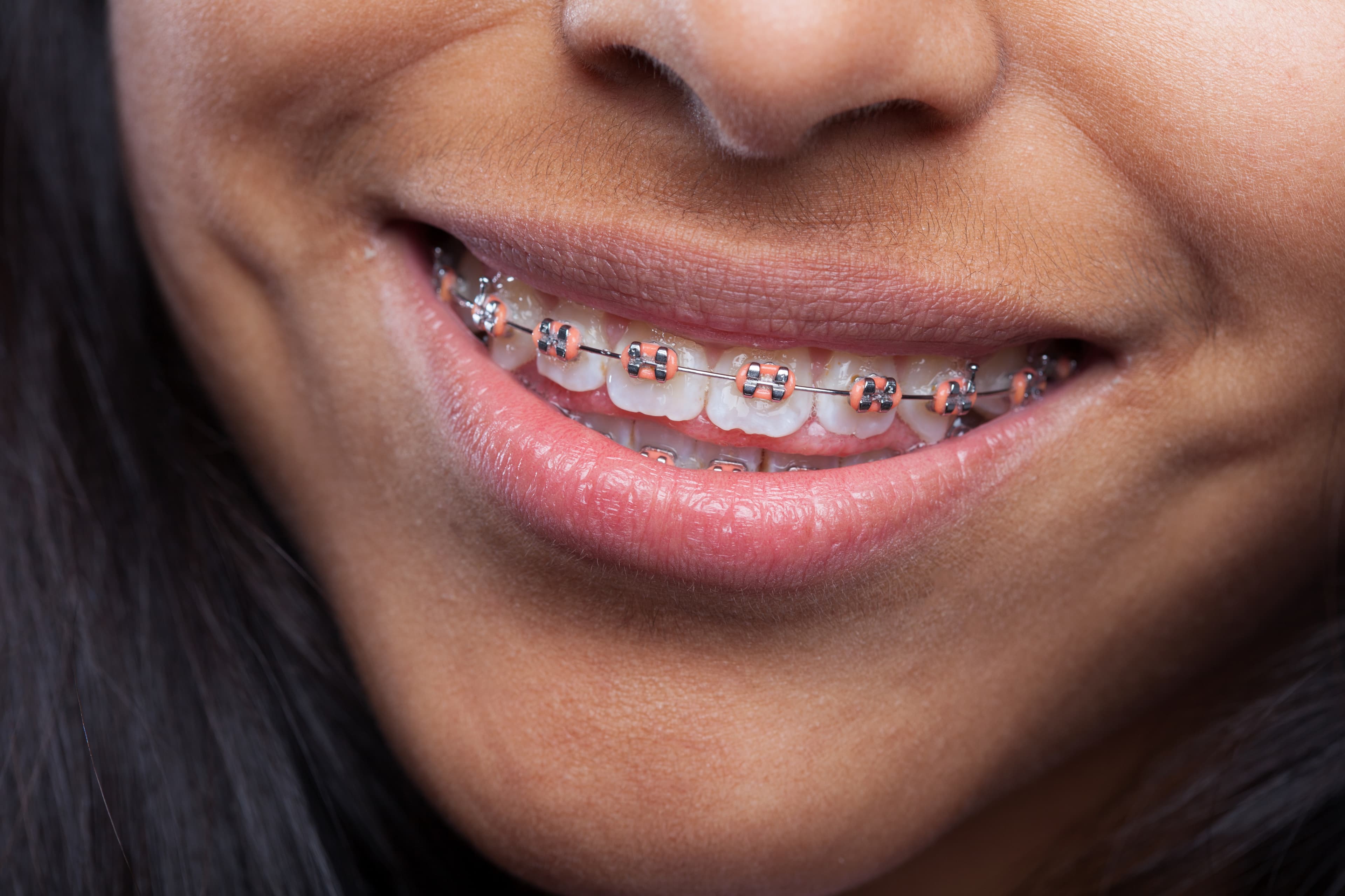 Person with braces smiling